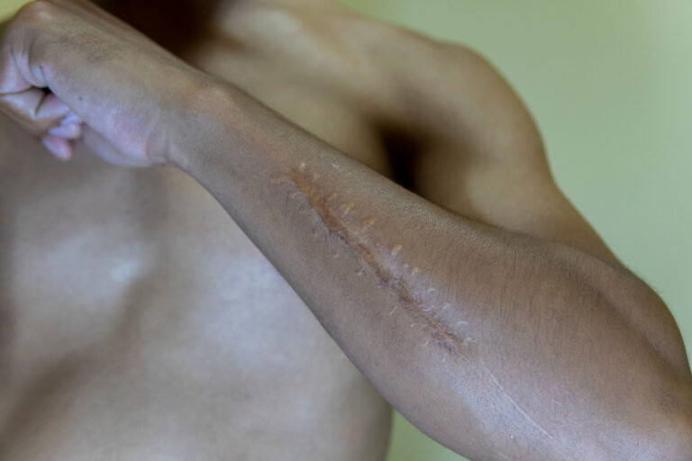 scars from service va