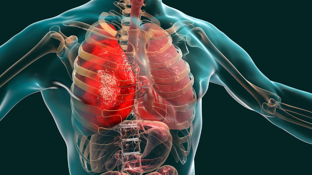 Diagram of Inflamed Lungs in Transparent Body