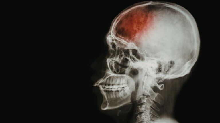 Black Background with Skull X-Ray and Red Brain Pain Indicator