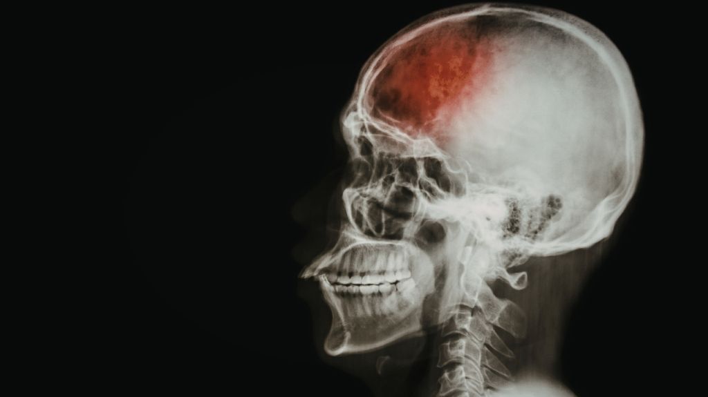 Black Background with Skull X-Ray and Red Brain Pain Indicator